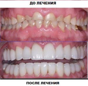 Utilizarea de furnir pentru a îmbunătăți aspectul dinților