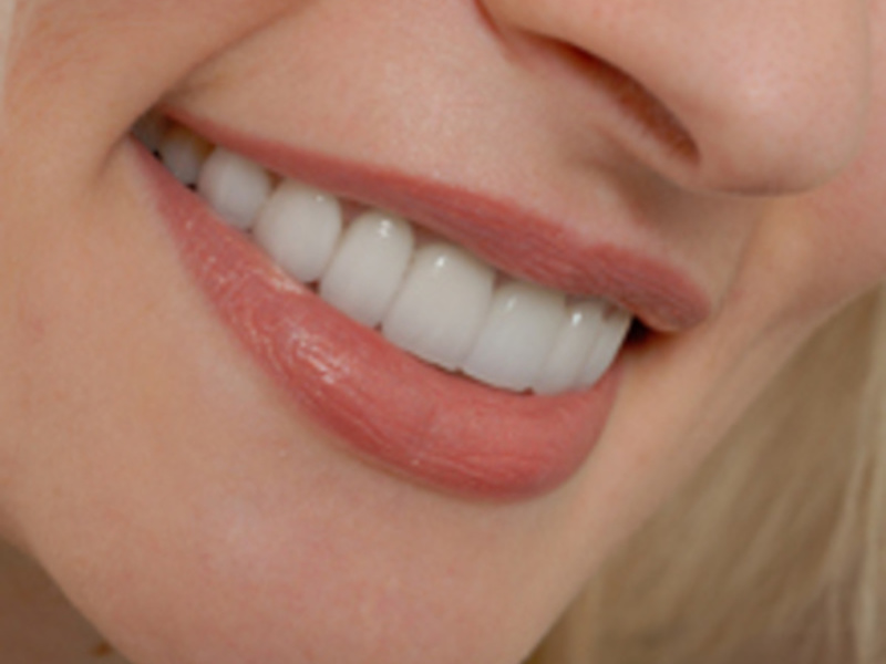 Smile Transformation - furnir ceramic Holograful zâmbește cu furnire