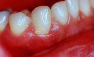 Prețul de pastă de adeziv dentar Solcoseryl