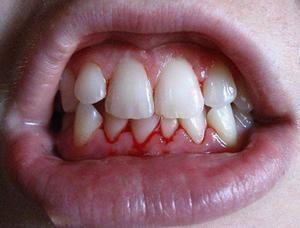 Inflamația gingiilor la un copil