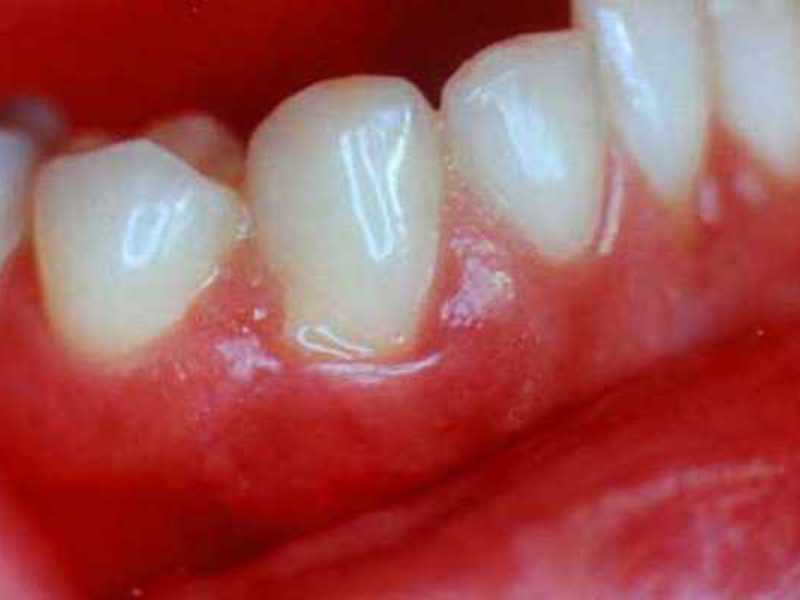Cum să tratați gingivita Cum să tratați gingiile umflate