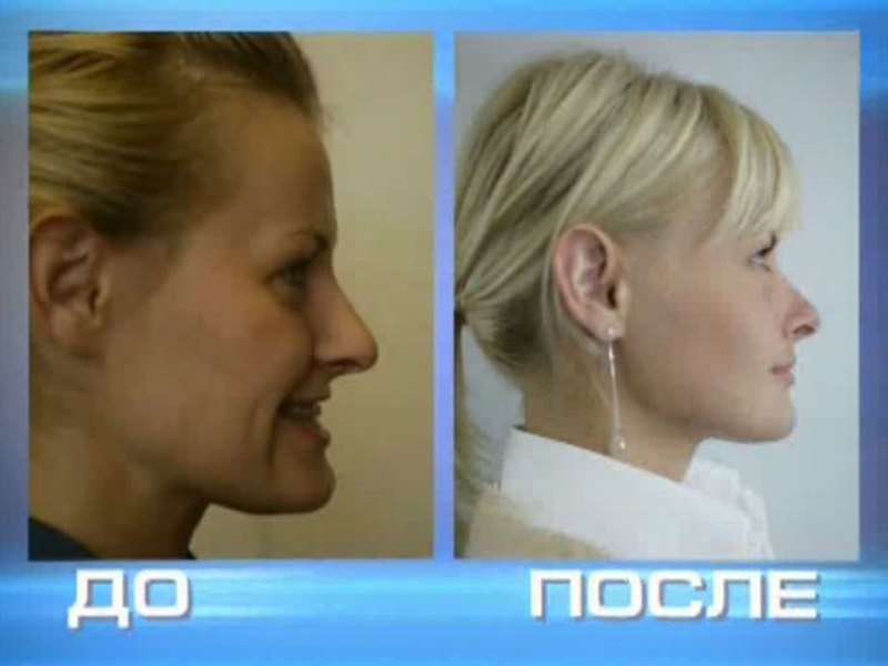 O mușcătură incorectă înainte și după Cauzele malocluziunii